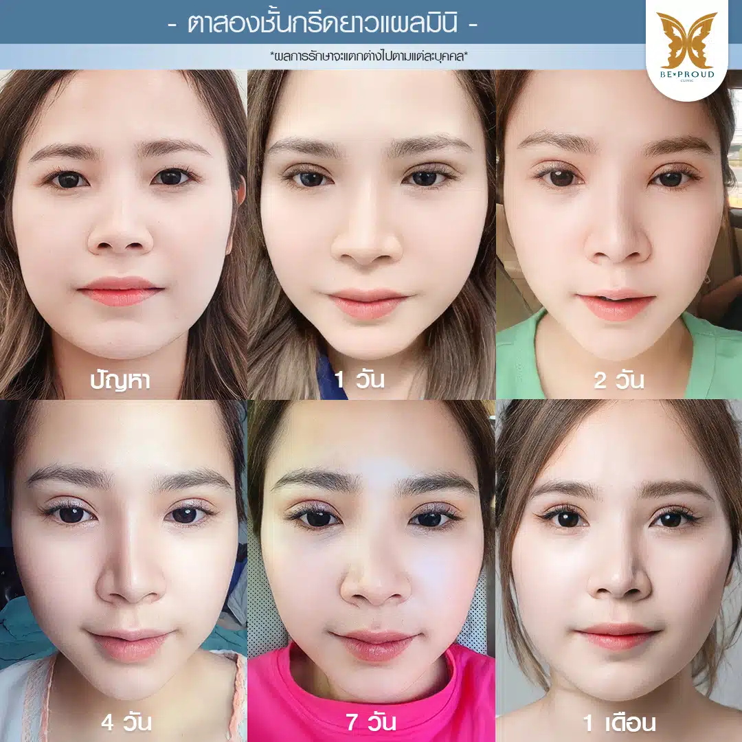 ตาสองชั้นกรีดยาวแผลมินิ บีพราวด์