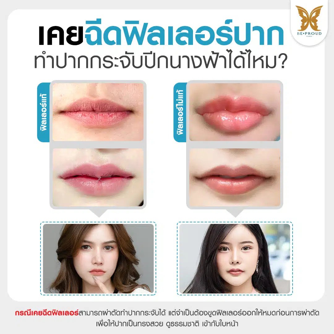 เคยฉีดฟิลเลอร์ทำปากกกระจับได้ไหม