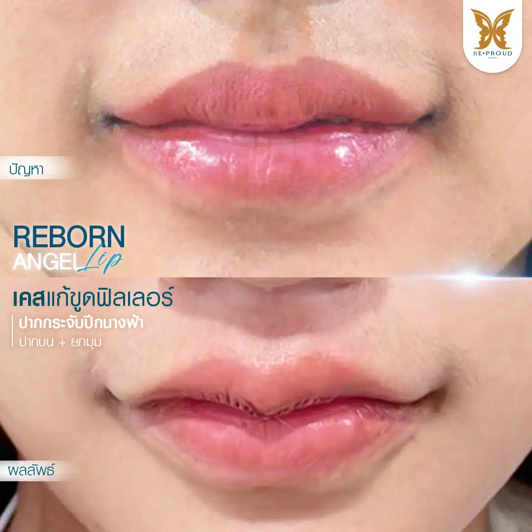 เคสแก้ขูดฟิลเลอร์