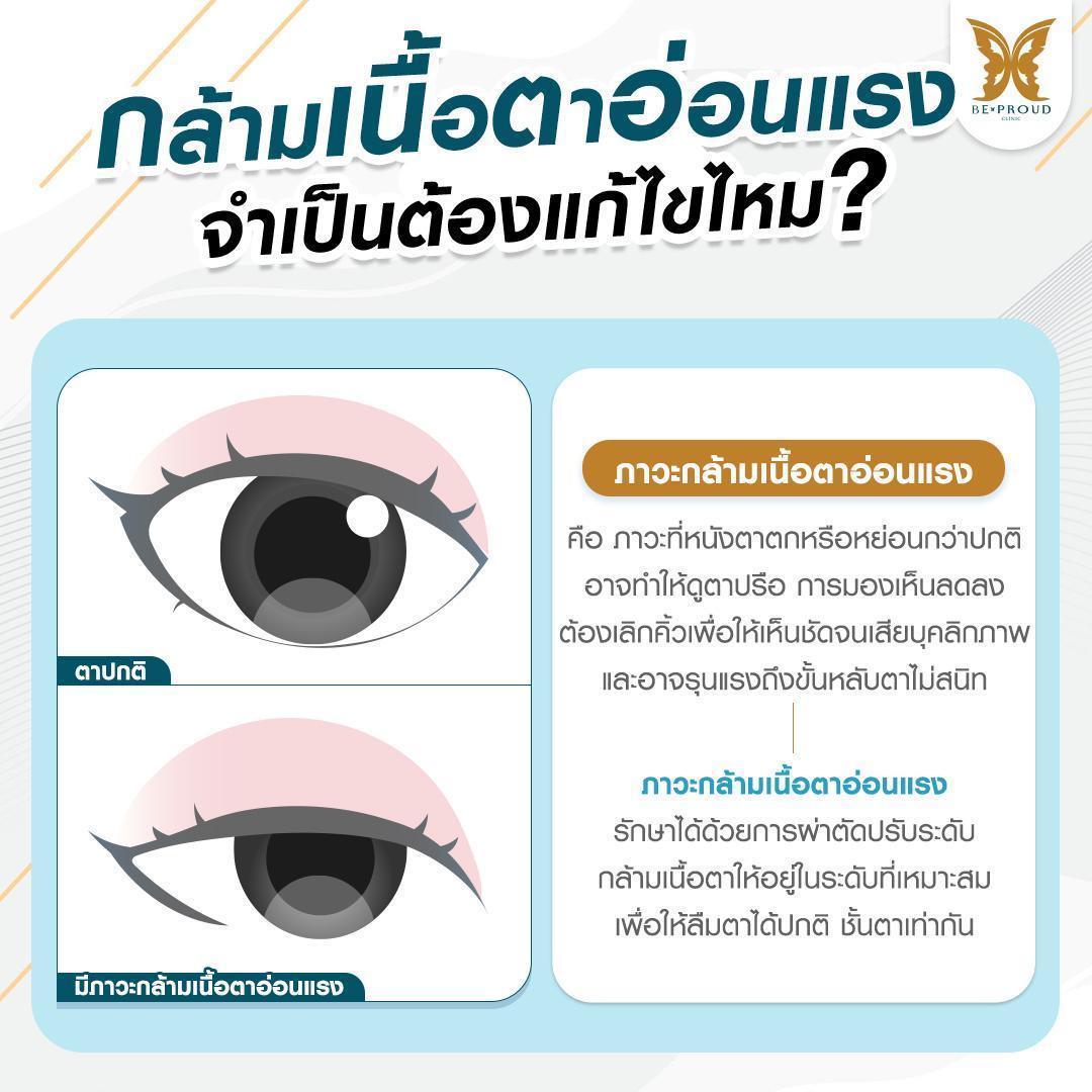ภาวะกล้ามเนื้อตาอ่อนแรง (Ptosis)