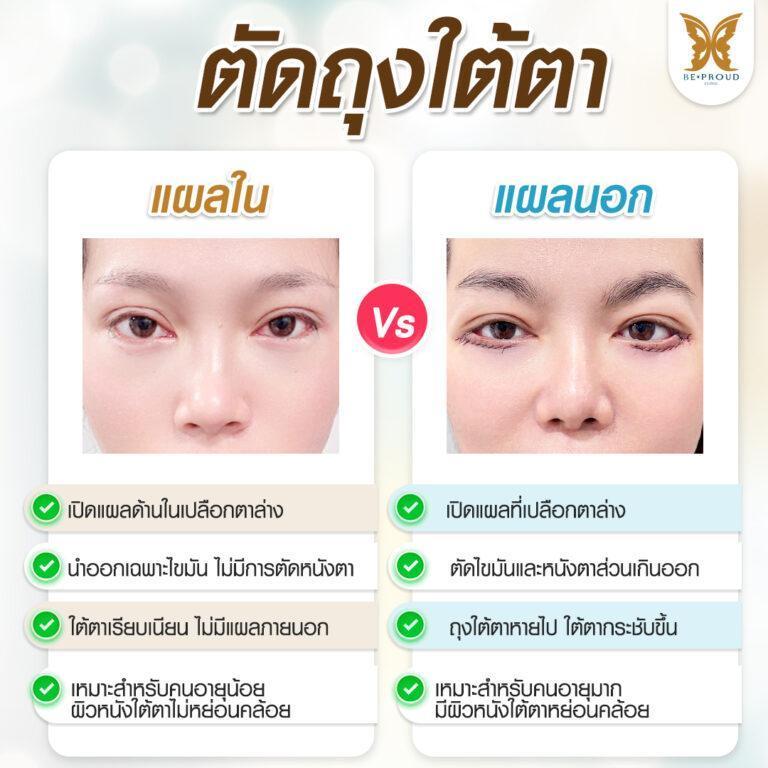 ตัดถุงใต้ตาแผลใน VS ตัดถุงใต้ตาแผลนอก