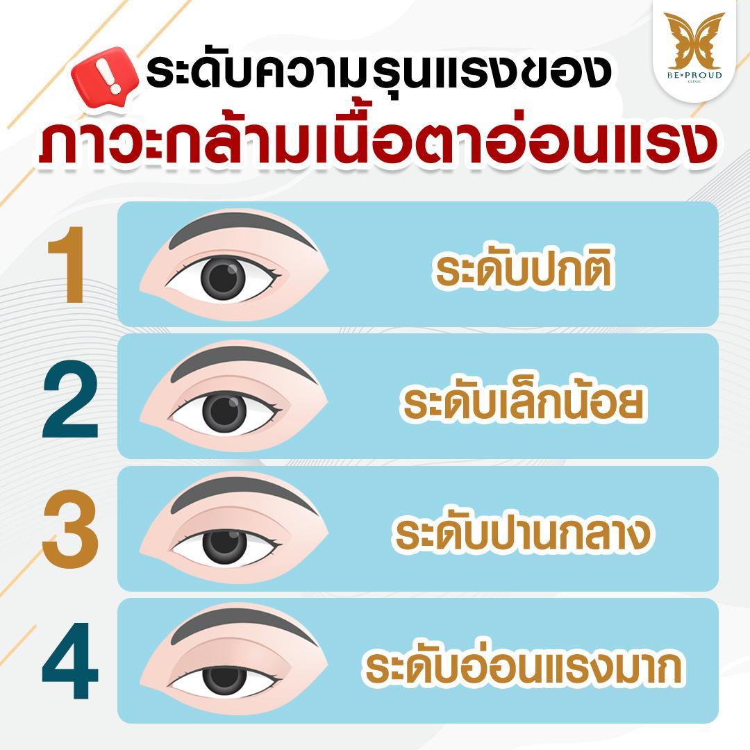 ภาวะกล้ามเนื้อตาอ่อนแรง (Ptosis)
