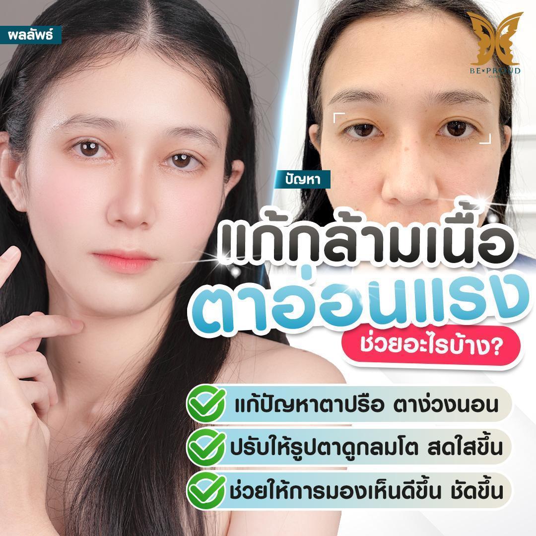 แก้กล้ามเนื้อตาอ่อนแรงช่วยอะไรบ้าง