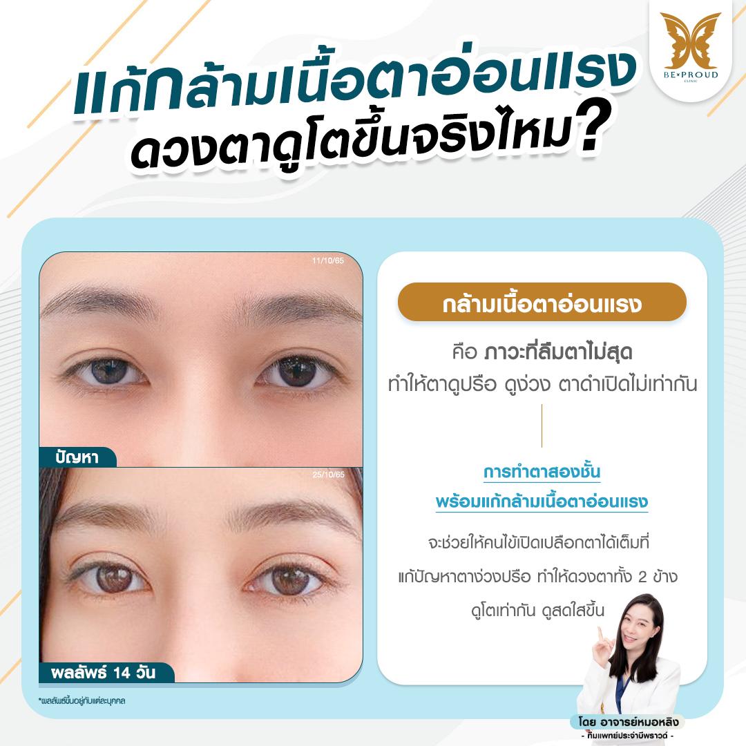 ตาสองชั้น เทคนิค แก้กล้ามเนื้อตาอ่อนแรง ทำให้ดวงตาเปิดกว้างและดูสดใสขึ้น ที่ บีพราวด์ คลินิก