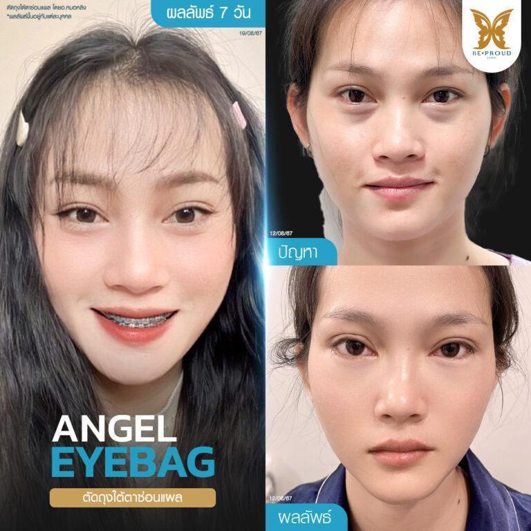 หัตถการตัดถุงใต้ตา ตัดถุงใต้ตาซ่อนแผล อ.หมอหลิง