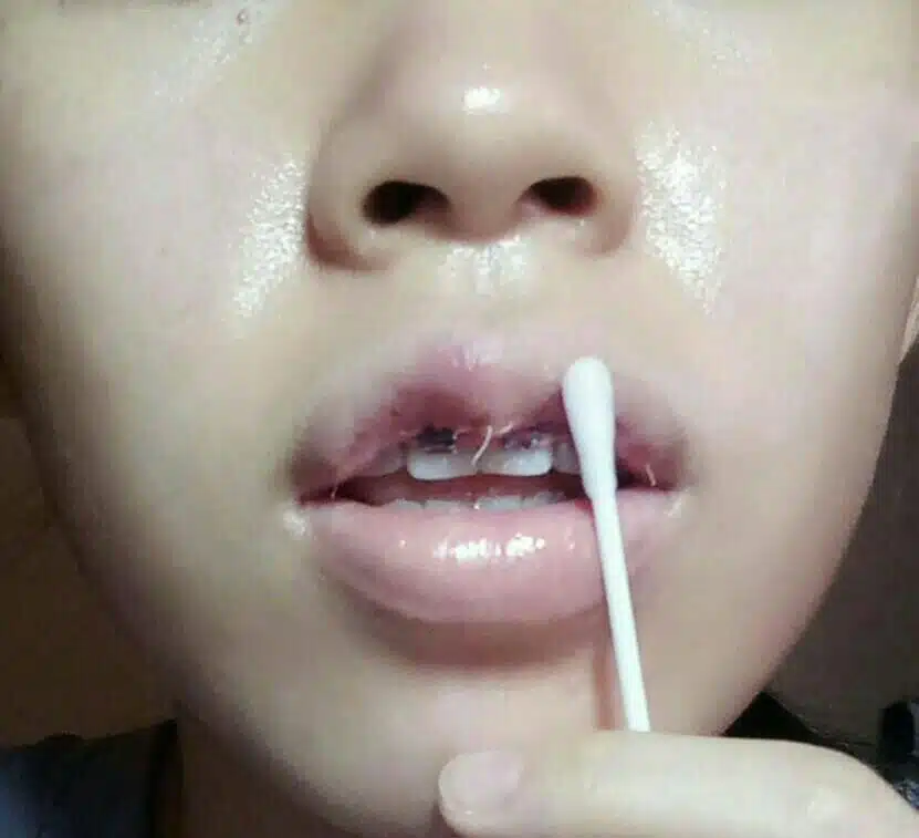 วิธีการล้างแผล