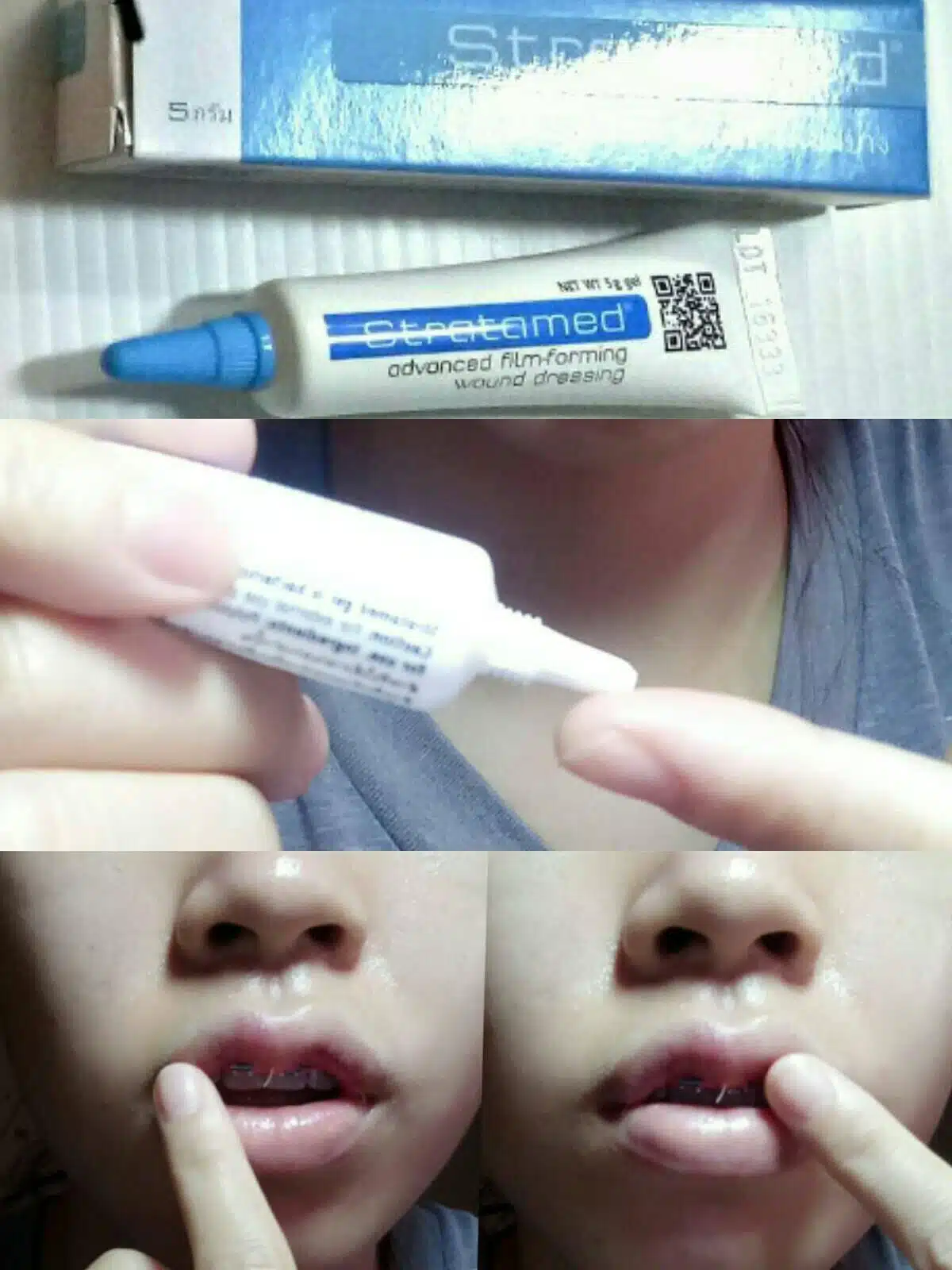 วิธีการล้างแผล