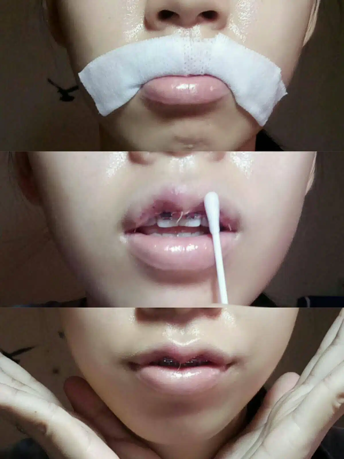 วิธีการล้างแผล