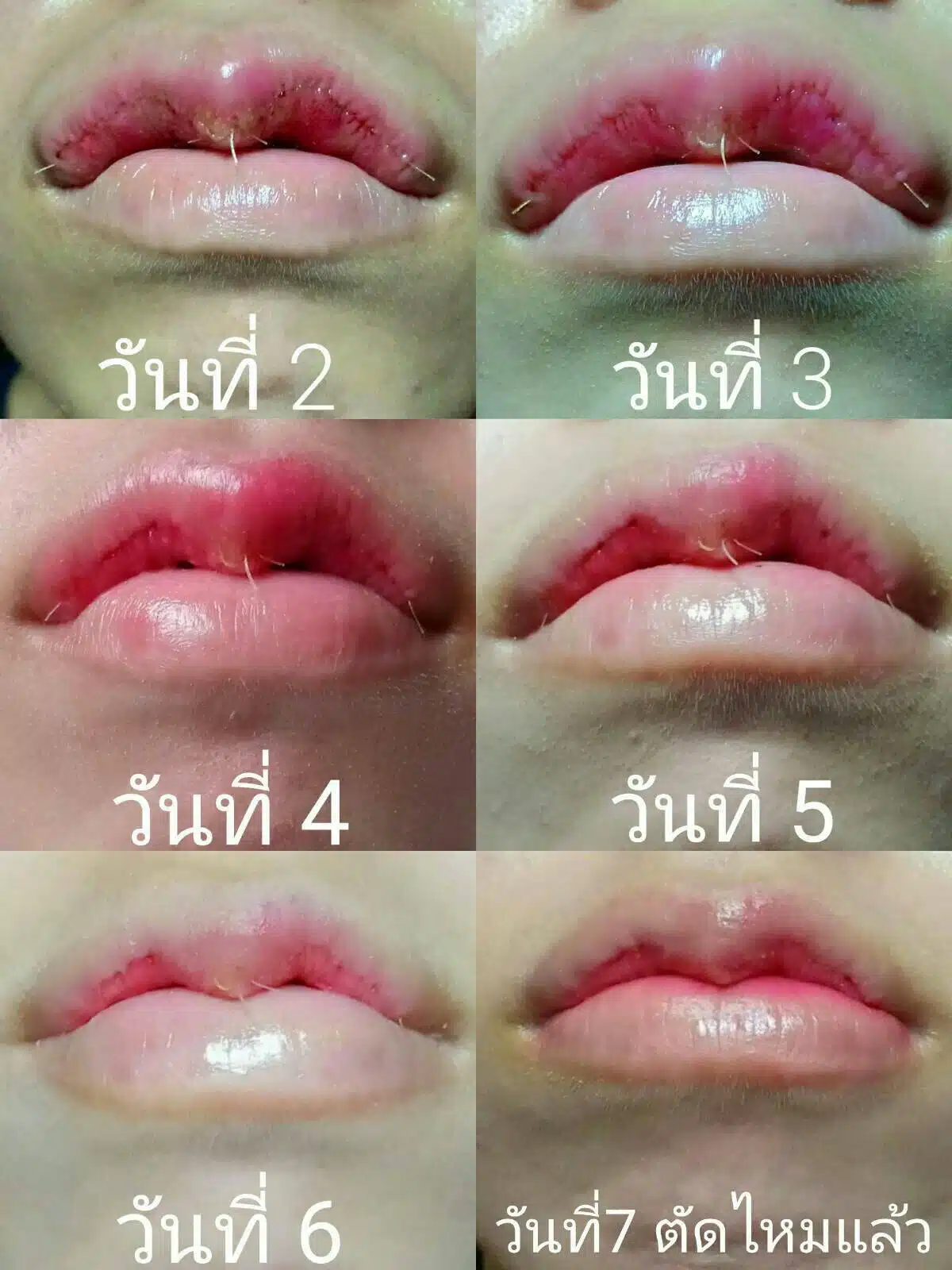 การดูแลตัวเองหลังศัลยกรรมปากกระจับ
