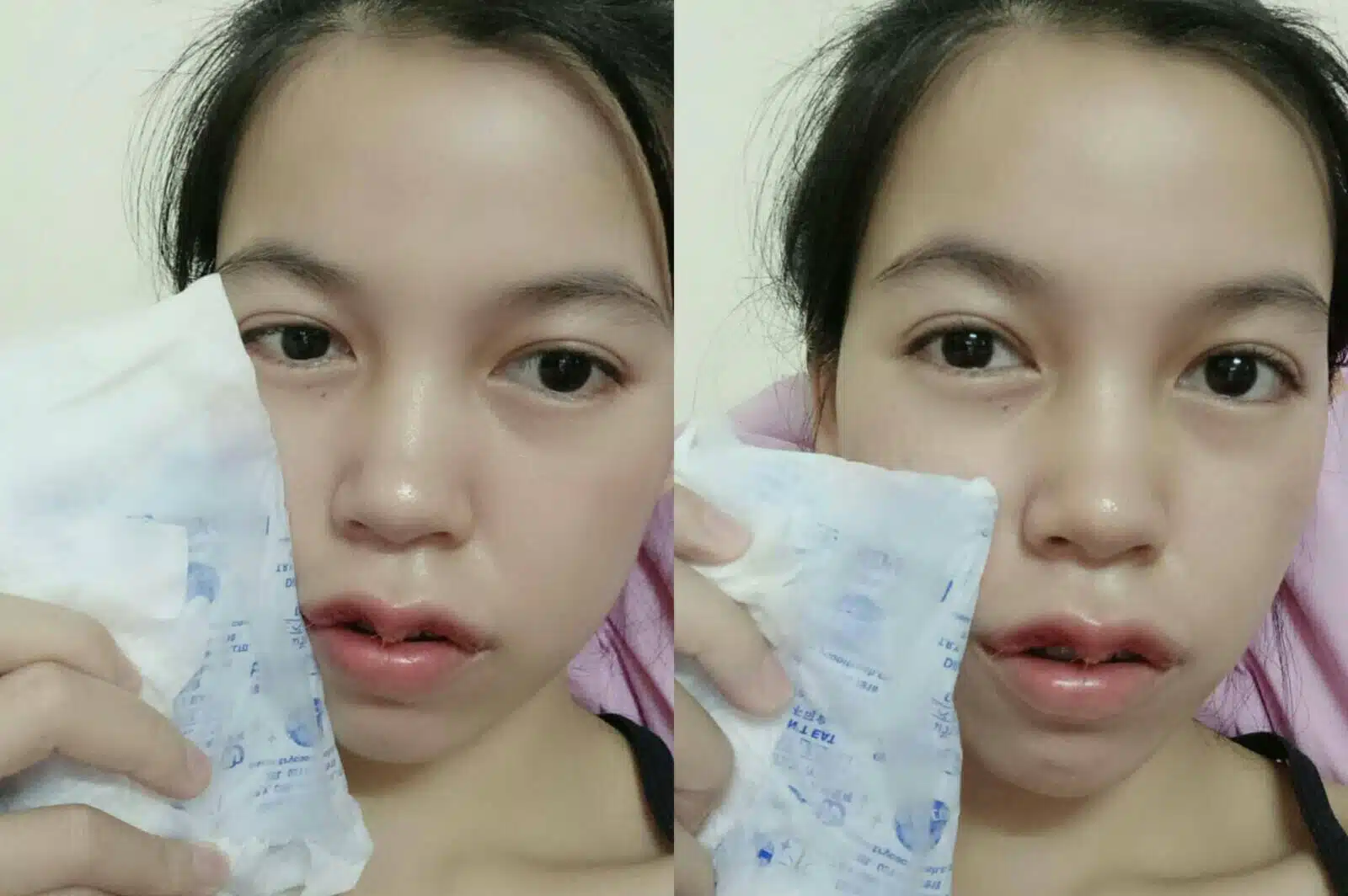 วีธีการดูแลตัวเอง หลังผ่าตัดปากกระจับ