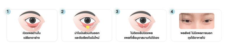 หัตถการตัดถุงใต้ตา ตัดถุงใต้ตาซ่อนแผล