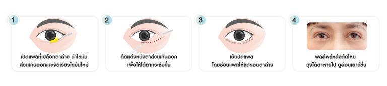 หัตถการตัดถุงใต้ตา ตัดถุงใต้ตาแผลนอก