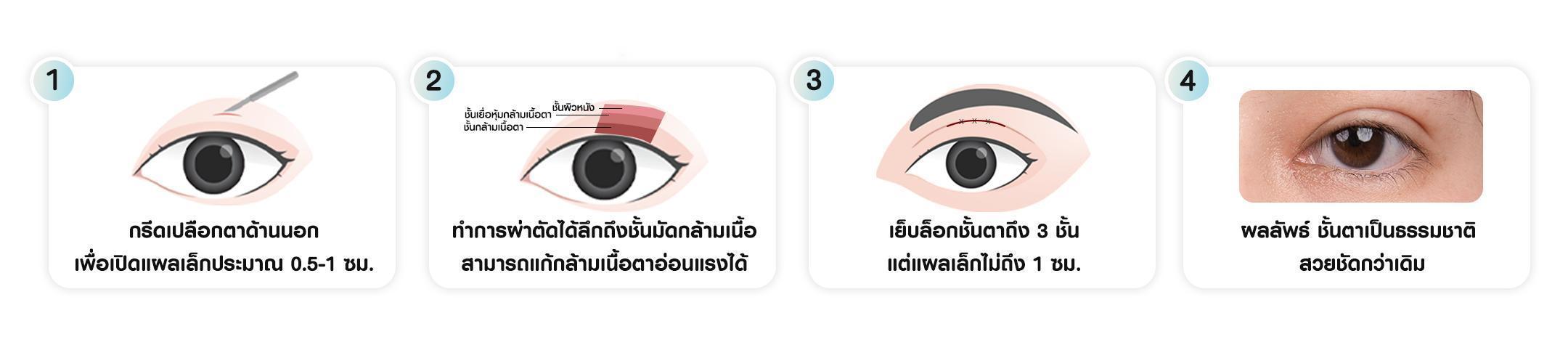 ขั้นตอนการแก้กล้ามเนื้อตาอ่อนแรง