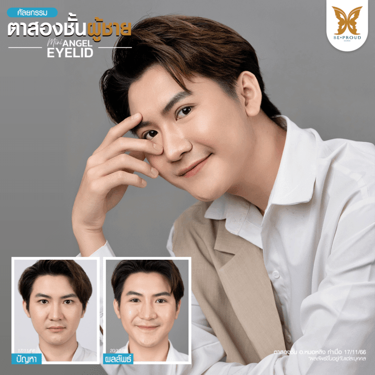 หัตถการตาสองชั้นผู้ชาย บีพราวด์