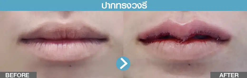 ปากทรงวงรี ทำปากกระจับ