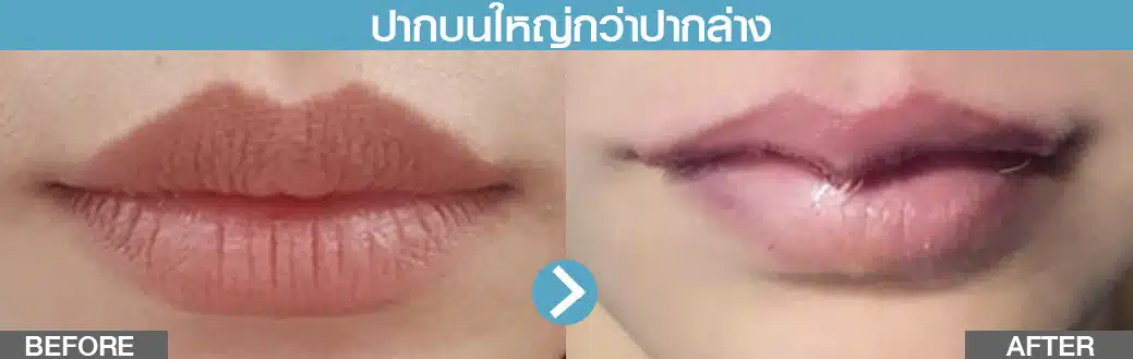 ปากบนใหญ่กว่าล่าง ทำปากกระจับ