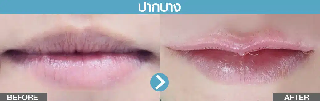 ปากบาง ทำปากกระจับ