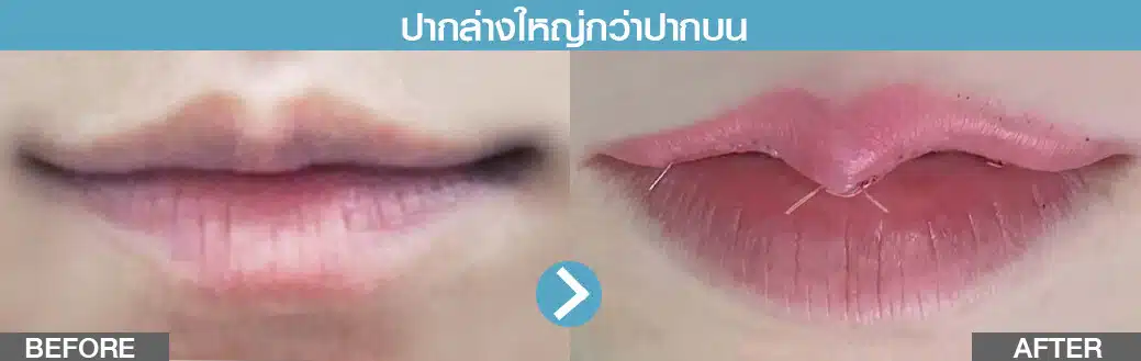 ปากล่างใหญ่กว่าปากบน ทำปากกระจับ