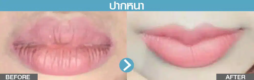 ปากหนา ทำปากกระจับ