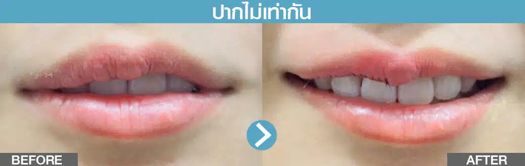 ปากไม่เท่ากัน ทำปากกระจับ
