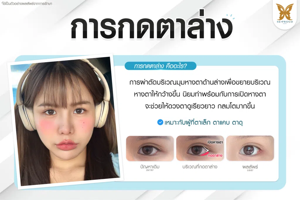 เทคนิคพิเศษตา หมอหลิง