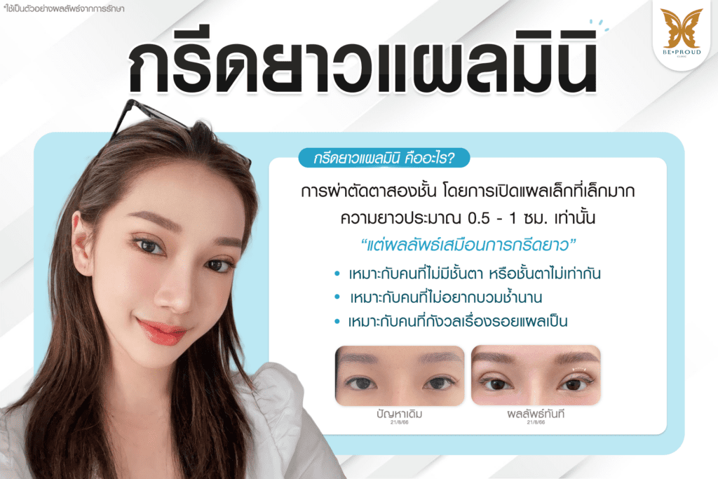 เทคนิคพิเศษตา กรีดยาวแผลมินิ