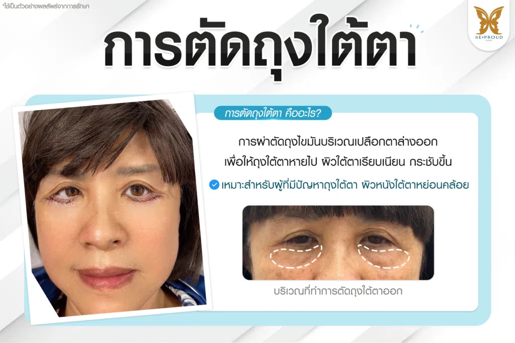 เทคนิคพิเศษตา หมอหลิง
