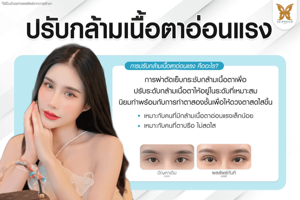 เทคนิคพิเศษตา ปรับกล้ามเนื้อตาอ่อนแรง