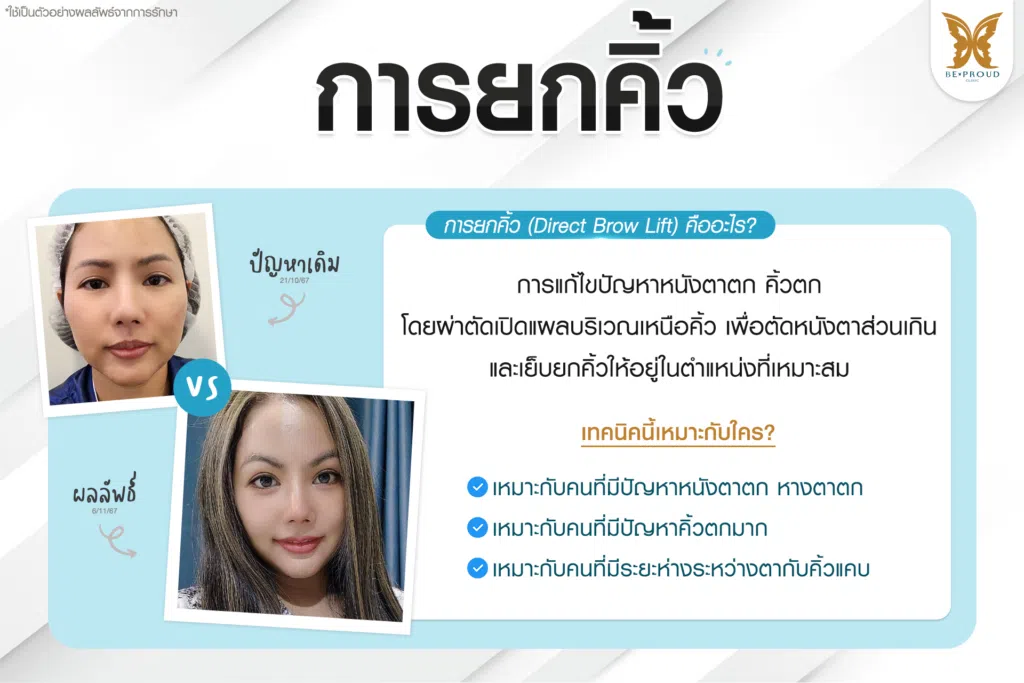 เทคนิคพิเศษตา หมอหลิง