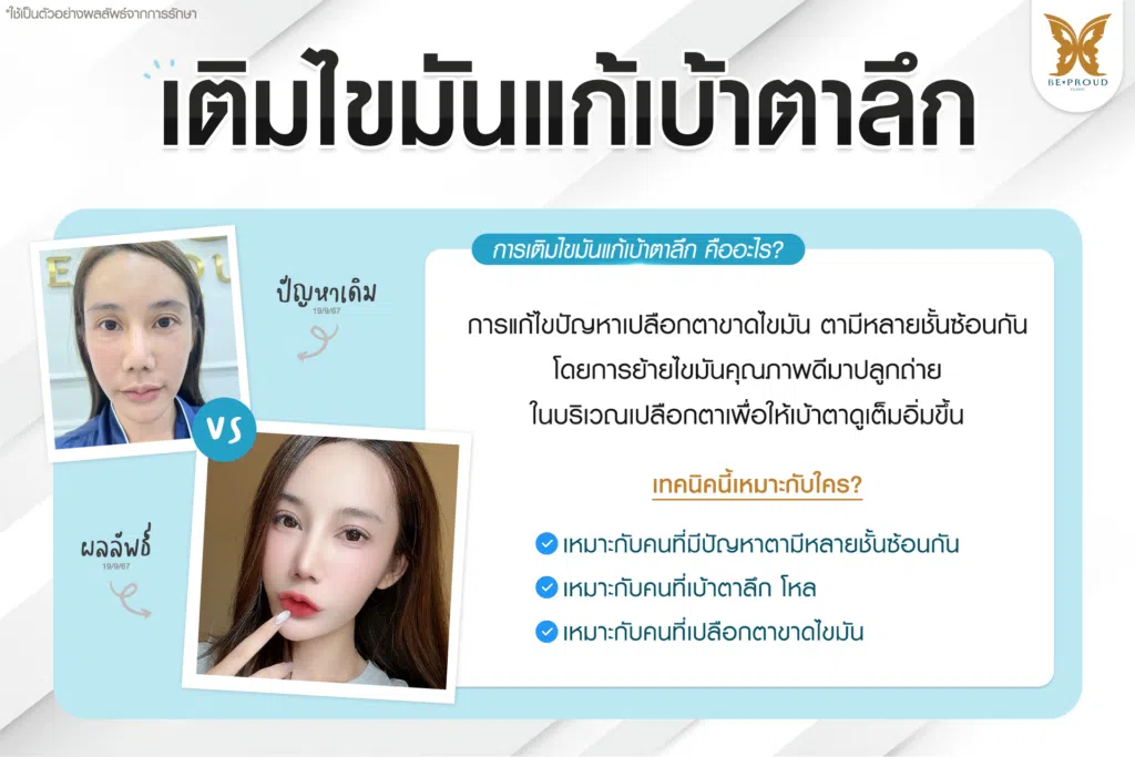 เทคนิคพิเศษตา หมอหลิง