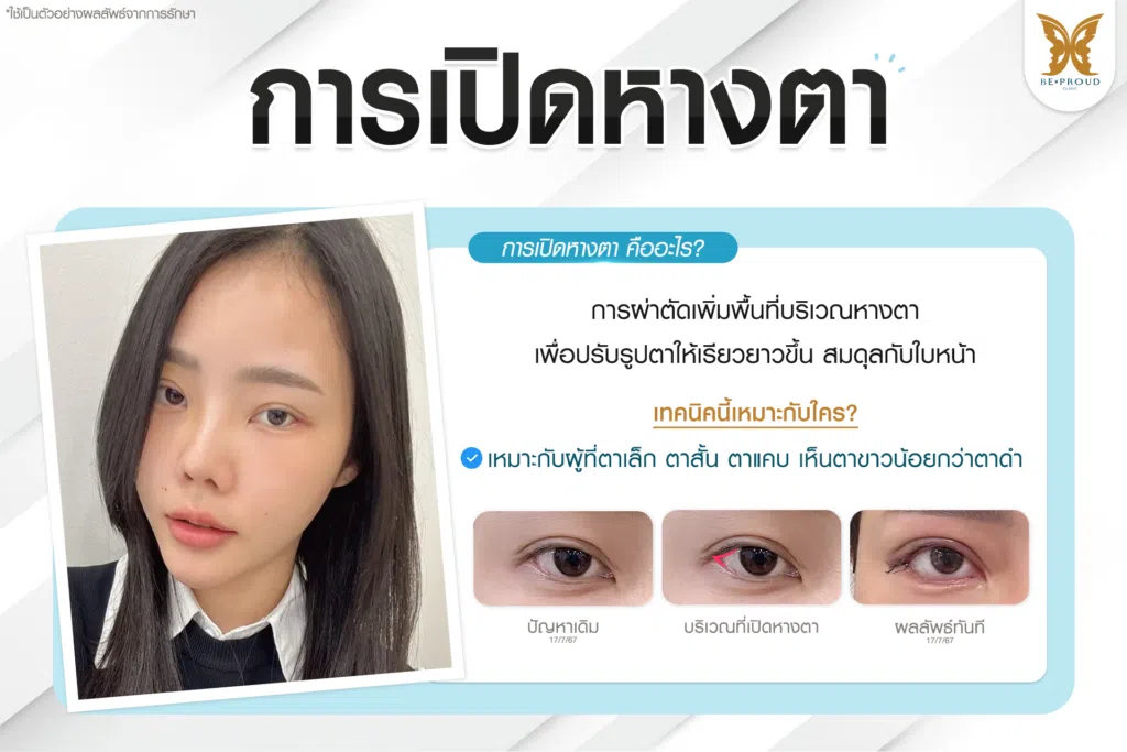 เทคนิคพิเศษตา หมอหลิง