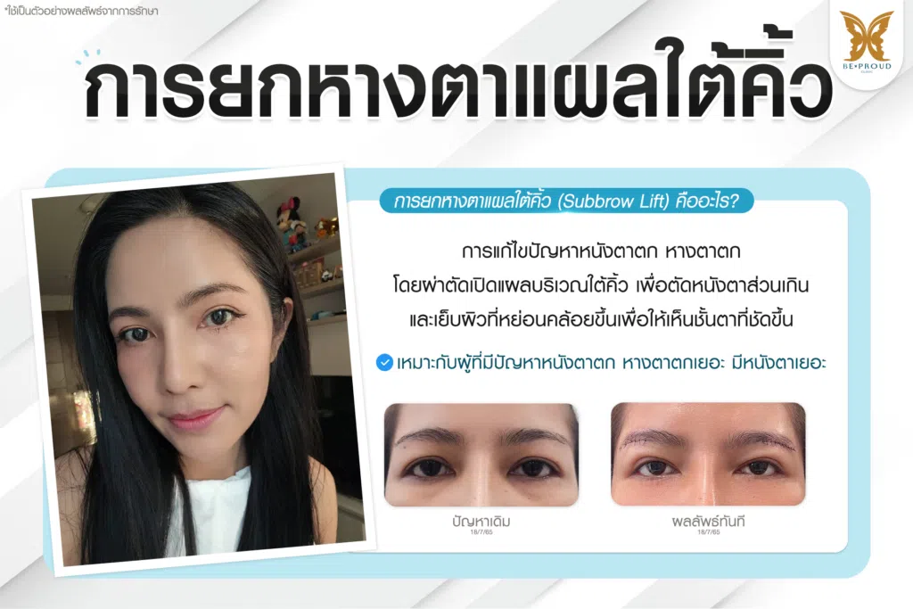 เทคนิคพิเศษตา หมอหลิง
