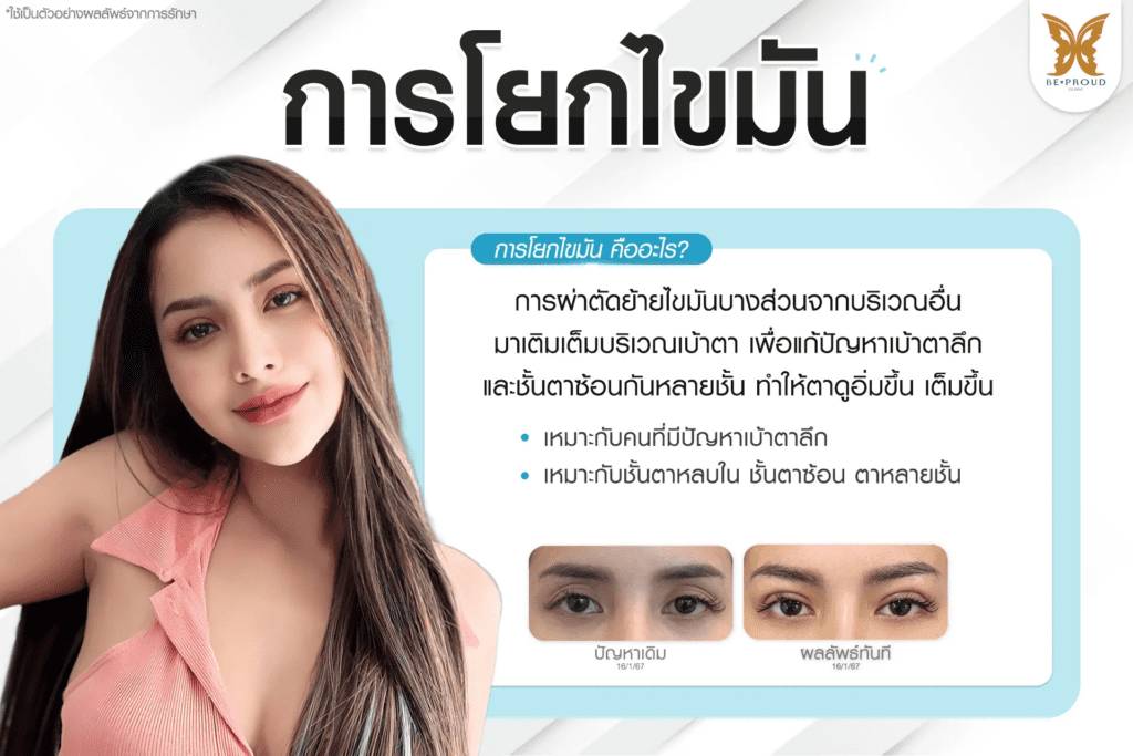 เทคนิคพิเศษตา โยกไขมัน