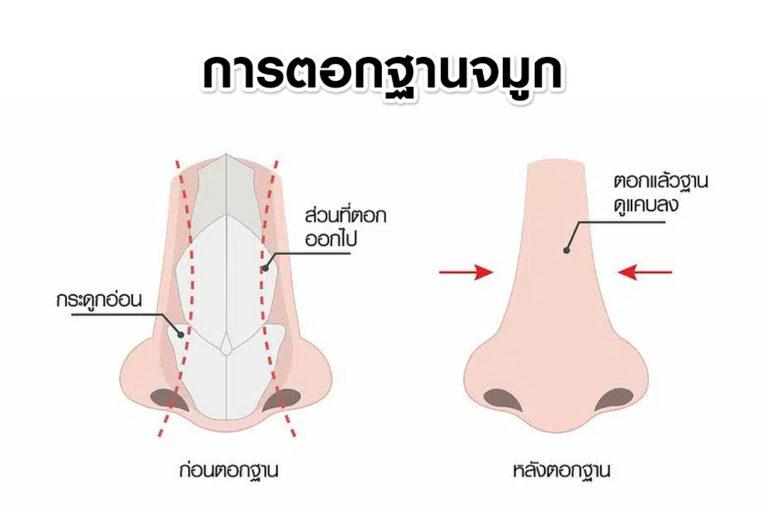หัตถการเสริมจมูก ตอกฐานจมูก