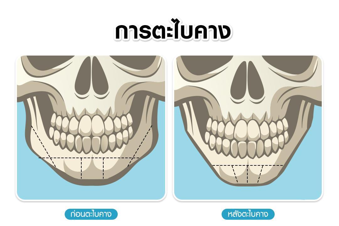 หัตถการเสริมคาง ตะไบคาง