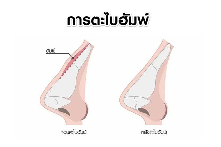 หัตถการเสริมจมูก ตะไบฮัมพ์