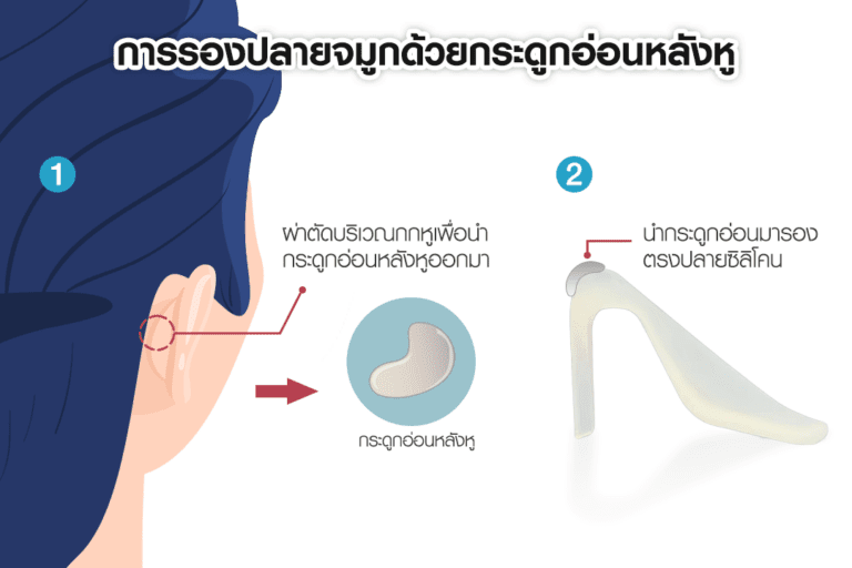 หัตถการเสริมจมูก บีพราวด์ คลินิก