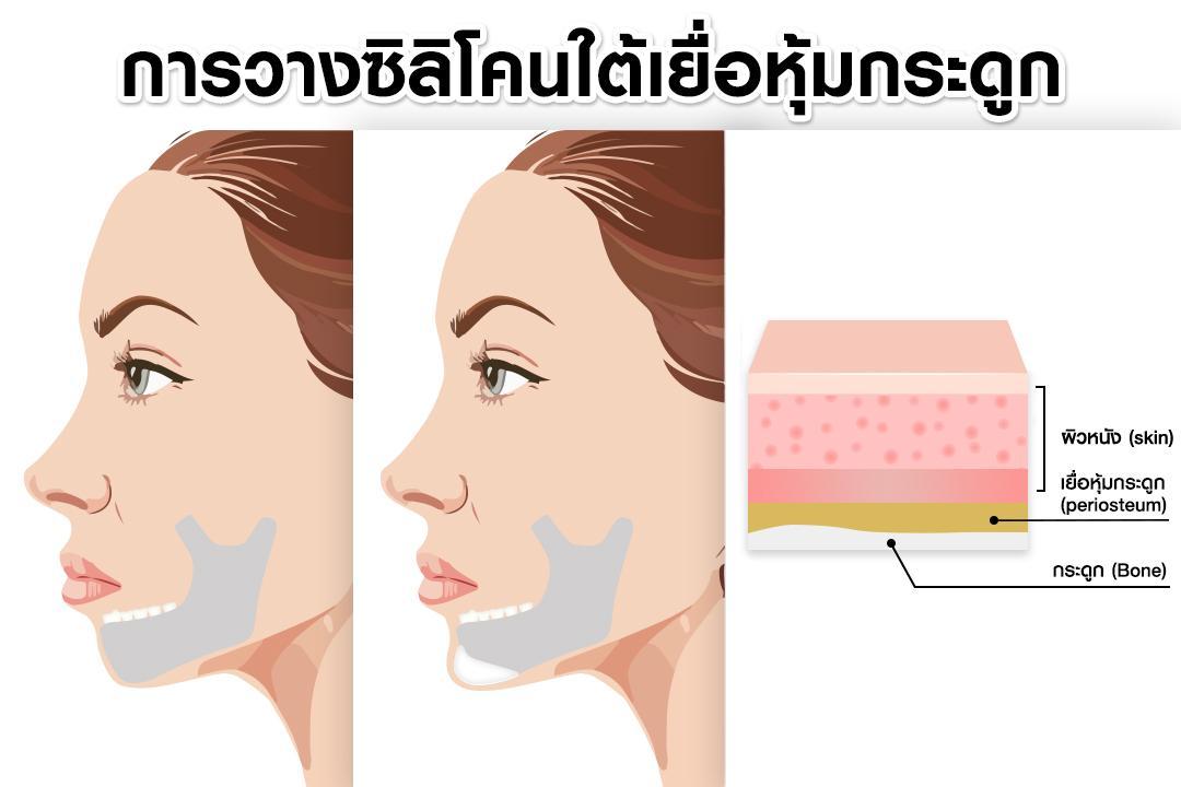 หัตถการเสริมคาง บีพราวด์ คลินิก