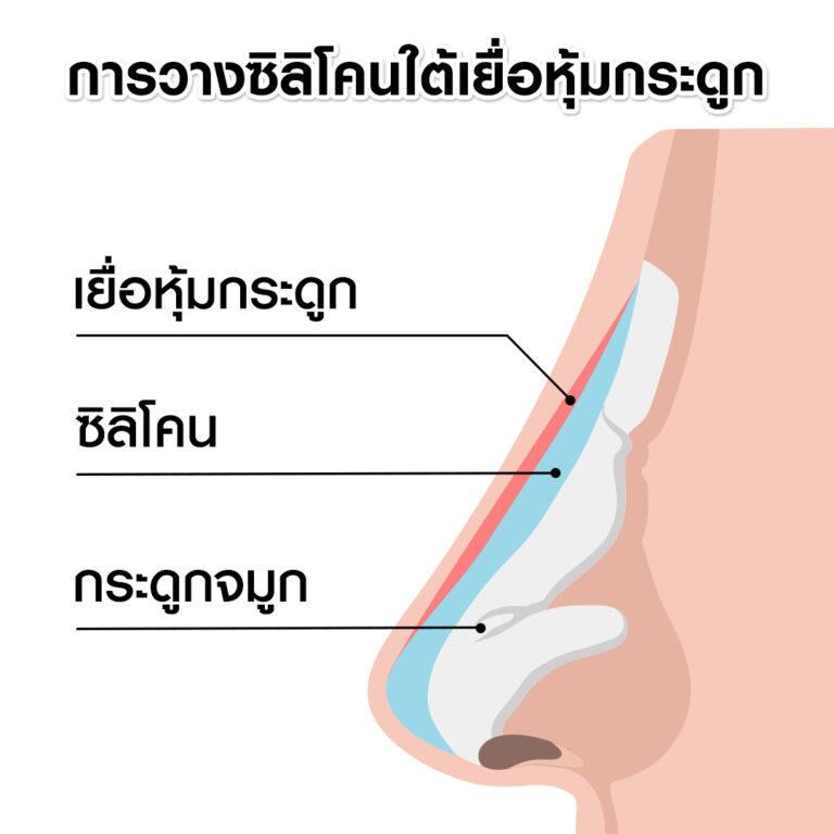 หัตถการเสริมจมูก บีพราวด์ คลินิก