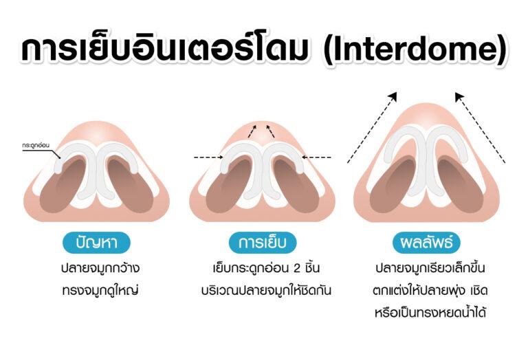 หัตถการเสริมจมูก เย็บอินเตอร์โดม