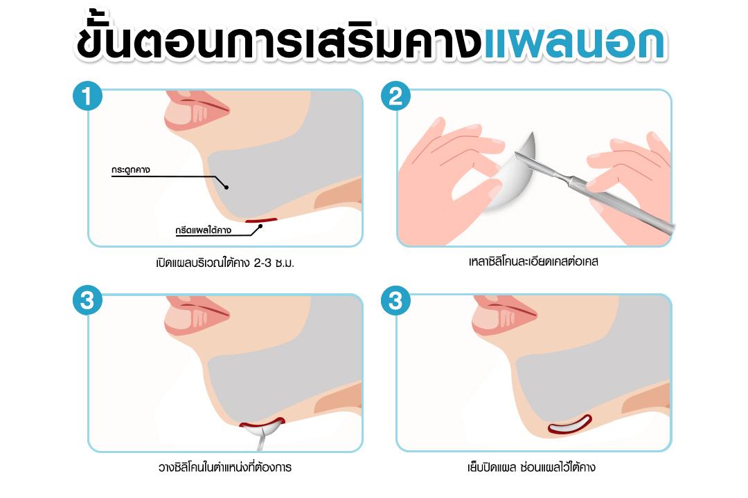 เสริมคาง บริการ - เสริมคาง - ไทย