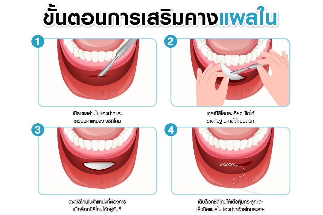 เสริมคาง บริการ - เสริมคาง - ไทย