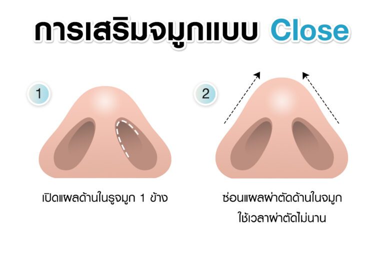 หัตถการเสริมจมูกแบบปิด Close Rhinoplasty