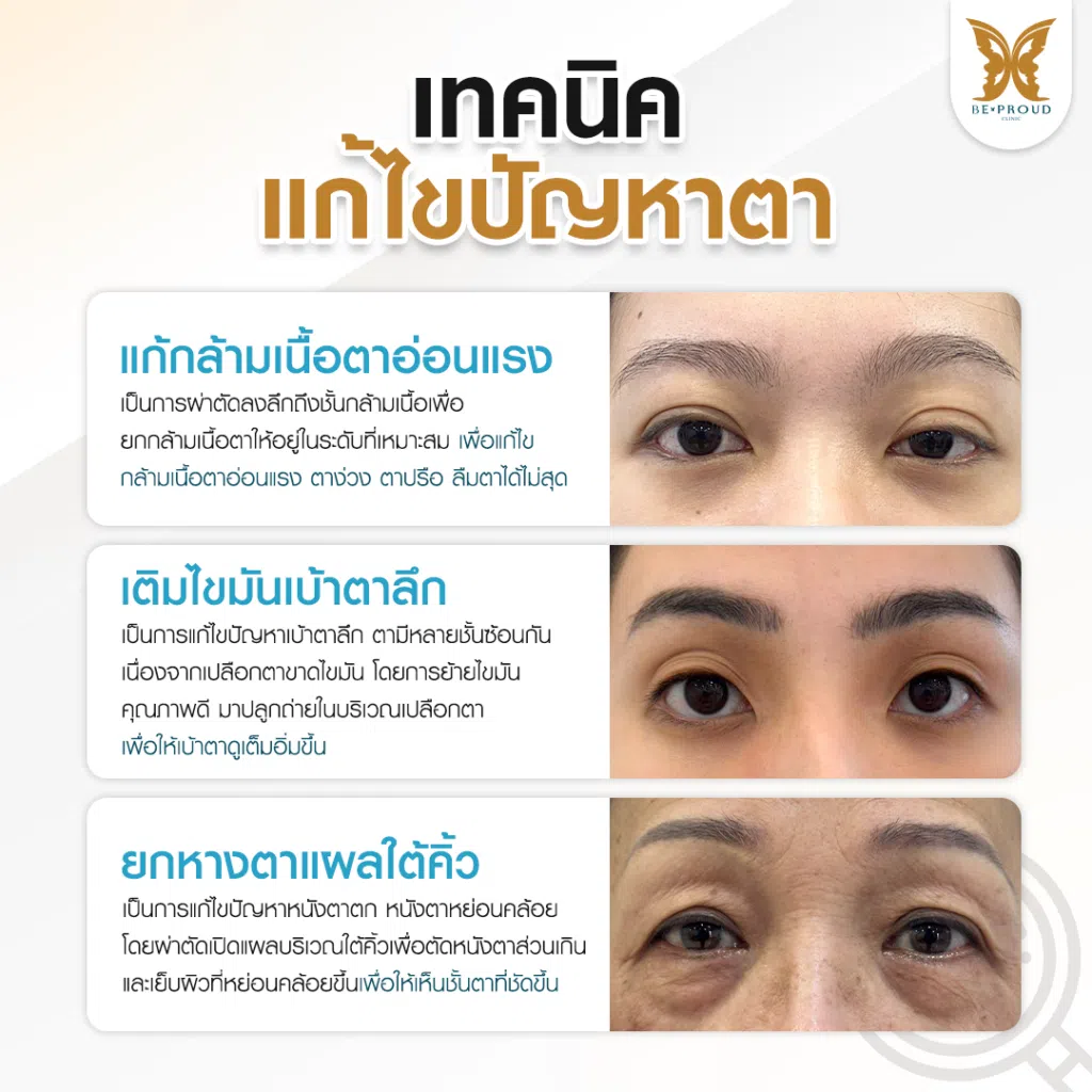 เทคนิคพิเศษตา หมอหลิง