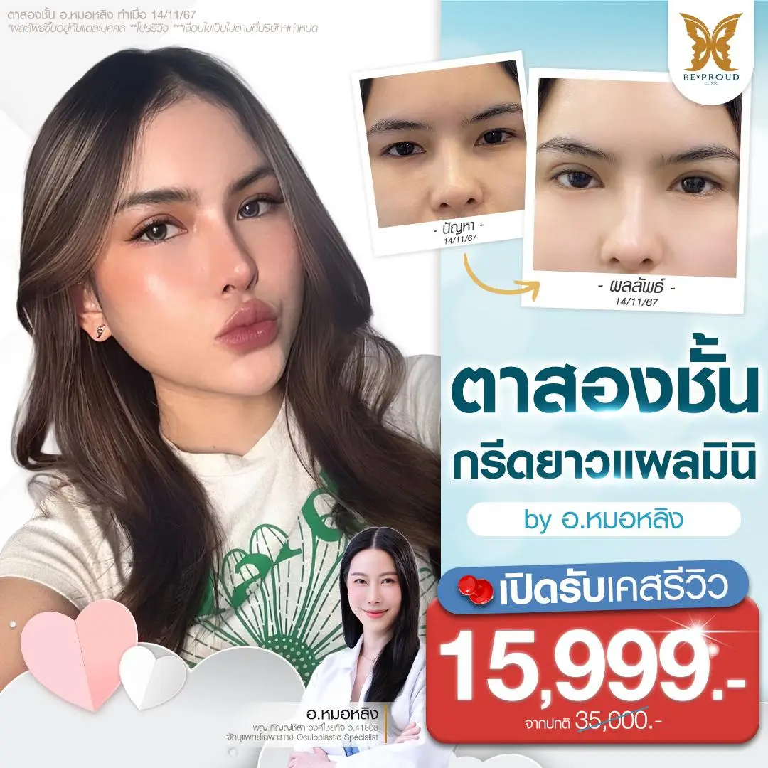 รีวิวตาสองชั้น รีวิวตาสองชั้นกรีดยาวแผลมินิ