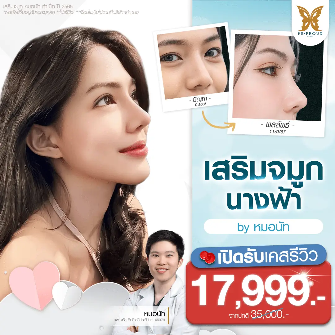 รีวิวเสริมจมูก ที่ บีพราวด์ คลินิก ทรงสวยเข้ากับรูปหน้าอย่างเป็นธรรมชาติ