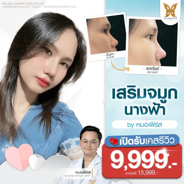 เสริมจมูก รีวิวเสริมจมูกนางฟ้า Slope Angel สวยละมุน Beproud Clinic