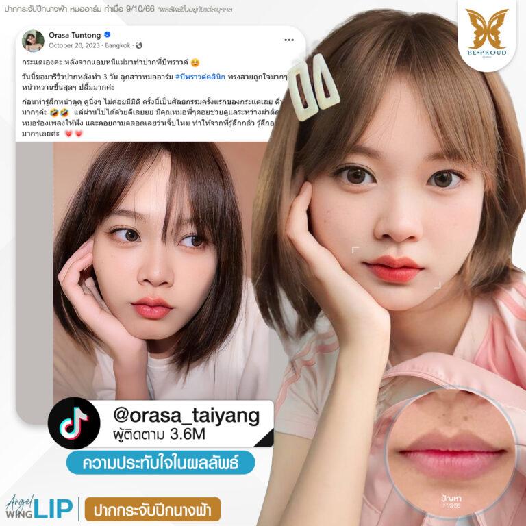 รีวิวความประทับใจศัลยกรรมวปากกระจับปีกนางฟ้า คุณ @orasa_taiyang แสดงภาพก่อนทำและหลังทำศัลยกรรม กับหมออาร์ม ที่บีพราวด์คลินิก