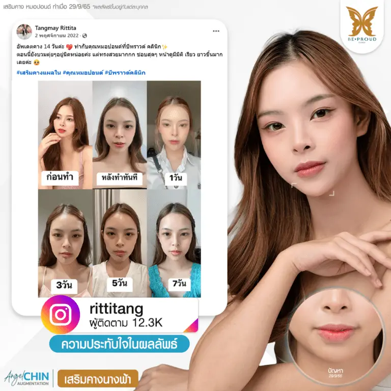 รีวิวความประทับใจศัลยกรรมเสริมคาง Angel Chin คุณ @rittitang แสดงการเปลี่ยนแปลงตั้งแต่ก่อนทำศัลยกรรม กับหมอปอนด์ ที่บีพราวด์คลินิก