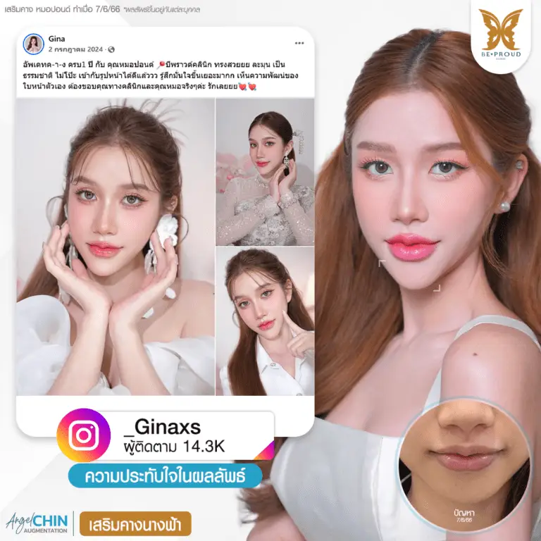 รีวิวความประทับใจศัลยกรรมเสริมคาง Angel Chin คุณ @_Ginaxs หลังทำครบ 1 ปี กับหมอปอนด์ ที่บีพราวด์คลินิก